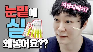 다크써클에 실 넣으면 좋아질까??(a.k.a 비절개 눈밑지방재배치)