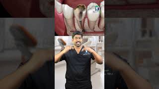 இந்தப் பற்களை எல்லாம் காப்பாற்றவே முடியாது! Hopeless Prognosis of Teeth |Dr.Karthikeyan |Denta Kings