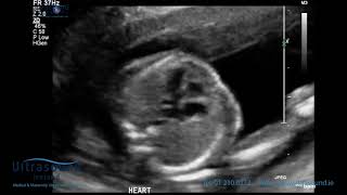 Baby Heart Motion At 12 Weeks II Ultrasound Ireland