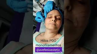 Hilos PDO monofilamentos para Rejuvenecer y regenerar colágeno y elastina. #avefenixestetic