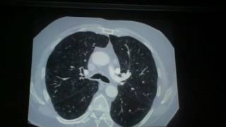 Cases in Chest Imaging Part 4 - Marie-Pierre Revel