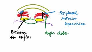 8 , GLAUCOMA , PRIMARY ANGLE CLOSER GLAUCOMA , Ophthalmology Lectures