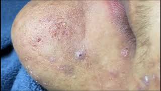 Acne clear - Blackhead removal - Beauty care video #62