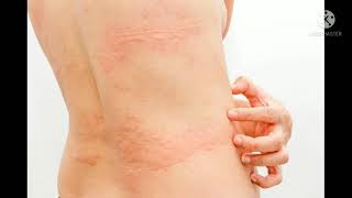 शरीर में पित्ती किसी भी स्थान पर उछलती है तो करें इसका उपयोग  allergy in body । my Ayurvedic  tips 2