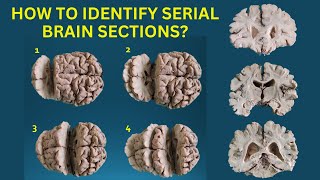 3D Sections of Brain | Coronal & Horizontal Sections | Anatomy Decoded