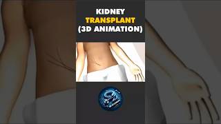 Kidney Transplant (3D Animation)