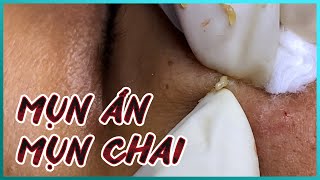 Big Cystic Acne Blackheads Extraction Blackheads & Milia, Whiteheads Removal Pimple Popping