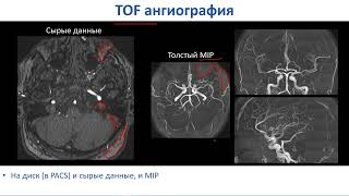 Головной мозг, основы сбора данных. Часть 5  tof и pc ангио