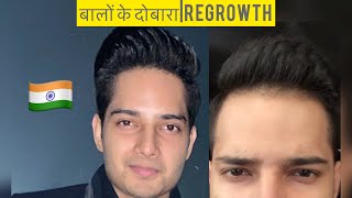 हेयरलाइन REGROWTH| RESULTS| RECEDING Hairline |Hairfall| Minoxidil Finasteride Hairtransplant| hindi