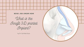 Advantages of 3D printed nasal implant Innofit