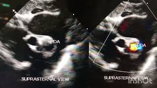 suprasternal view - PDA on 2D and color Doppler Echocardiography