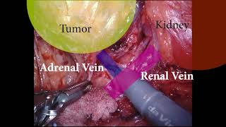 #357 Robotic bilateral cortical sparing Adrenalectomy- Dr. Saurabh Patil