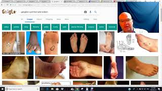 DIY FIX GANGLION CYST HOW TO remove foot home remedies easy pain free DMSO SALICYCLIC removal cure