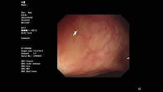 [Sample video]  Total colonoscopy : no cap OLYMPUS 290 + CF-H260AL