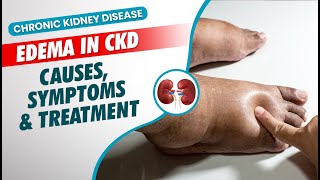 Causes, Symptoms & Treatment of Edema | Leg swelling Problem SOLVED