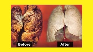 How To Purify Your Lungs In 72 Hours | Clean Lungs Naturally In 3 Days