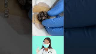 Dr.Nattacha, big blackheads infected extraction.