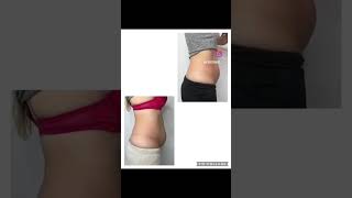 Postpartum Belly Fat Reduction & Skin Tightening using BodyFX by InMode