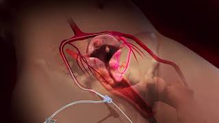 Uterine Fibroid Embolization UFE at California Vascular & Interventional (CVI) Southern California