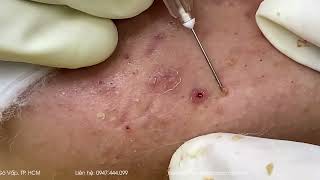 Big Cystic Acne Blackheads Extraction Blackheads & Milia, Whiteheads Removal Pimple Popping