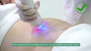 Vacuum microneedle RF treatment notice