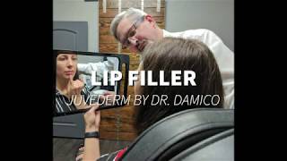 Lip Filler by Dr. Damico