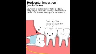 Horizontally Impacted 3rd Molar Extraction - Without Bone Removal