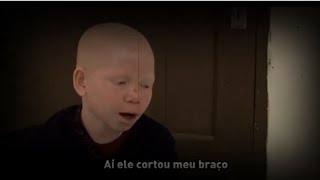 O TERROR DOS ALBINOS  NA ÁFRICA