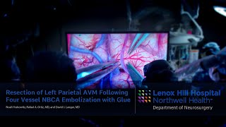 Resection of Left Parietal AVM Following Four Vessel NBCA Embolization with Glue