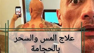 علاج المس الشيطاني والسحر بالحجامة