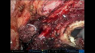 #182 R A RADICAL PARAMETRECTOMY WITH BILATERAL PELVIC L N D IN CERVICAL CANCER