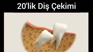 20'LİK DİŞ ÇEKİMİ