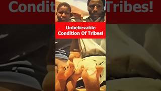 Dangerous Genetic Disorder In Tribes. #shorts