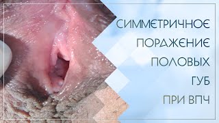 Симметричное поражение половых губ при ВПЧ. Клинический случай №13