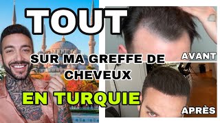 MA GREFFE DE CHEVEUX EN TURQUIE | TOUT SUR MON EXPÉRIENCE