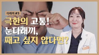 [다래끼 Part 3] 눈다래끼 hordeolum 극한의 고통! , 째고 싶지 않다면? | Korean ophthalmology