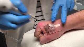 Removal of hand tattoo using the PFD Describe Patch