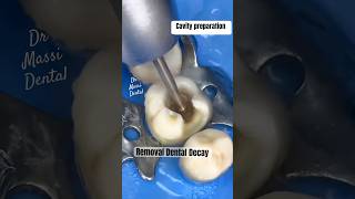 Removal Dental Decay on Molar tooth