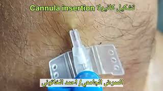 تشكيل كانيولا Cannula insertion