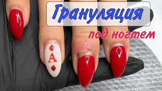 Рана под ногтем / грануляция под кутикулой / трещина на ногте