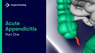 Acute Appendicitis Part 1| What is it and What's the Important Anatomy?