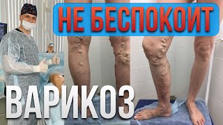 Варикоз не беспокоит, нужно ли лечить?