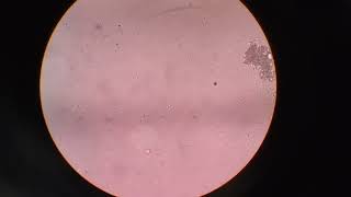 Normozoospermia & Oligozoospermia ...(semen slide under the microscopy 40x)