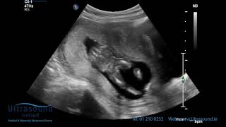 Scan of the Week: 15 Weeks Pregnant (The Advanced Early Ultrasound)