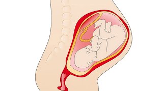 Le décollement du placenta