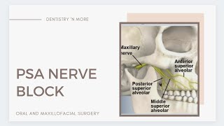 PSA (POSTERIOR SUPERIOR ALVEOLAR ) NERVE BLOCK.