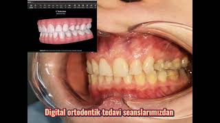 şeffaf plak tedavisi /aligner treatment