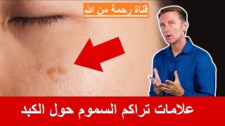 تسع علامات تنذرك بتراكم السموم في الكبد - دكتور بيرج