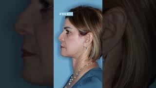 Experience the Awake Deep Plane Facelift: Stunning Results with Oral Sedation 🌟✨