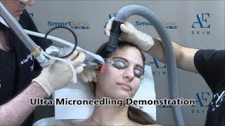 Ultra Microneedling Demonstration 22 - A E Skin - Encino, CA - 818-835-1833